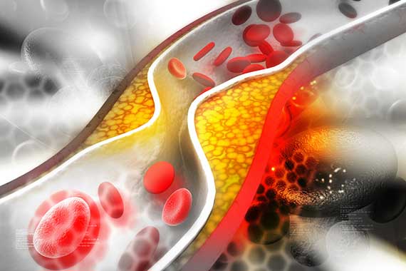 bionutrimed nutrizione catania ipercolesterolemia